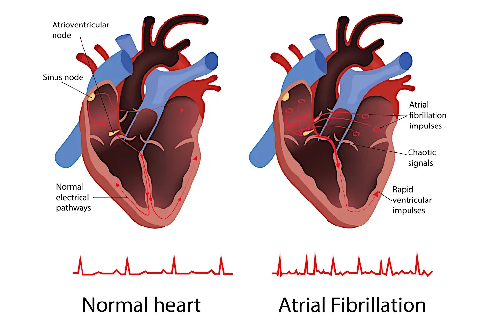 Ilustração comparando coração normal e fibrilação atrial